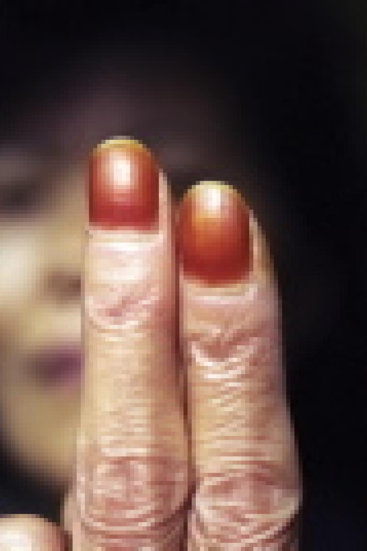 Nahaufnahme von zwei Fingern mit roten Nagelbetten vor einem unscharfen Hintergrund.