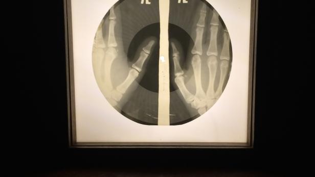 Ein Röntgenbild von zwei Händen, die ein Friedenszeichen formen, in einem Rahmen.